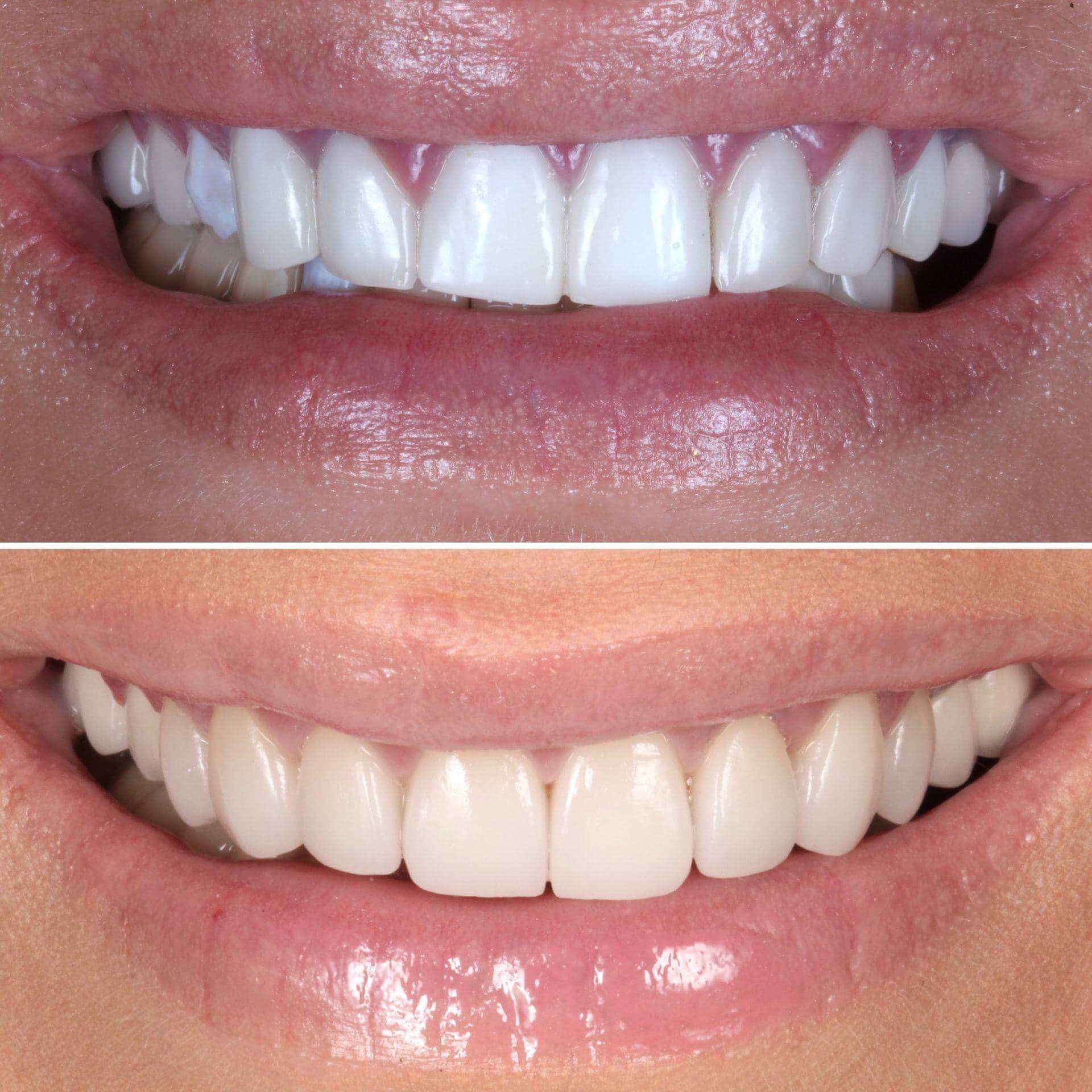 Before and After Replacing Unhealthy Veneers